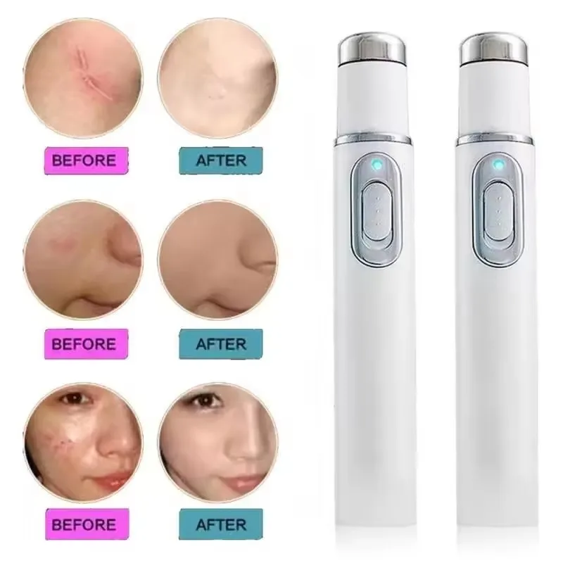 Perangkat Kecantikan Mata Tera - Acne Light Therapy Pen ulasan dan harga