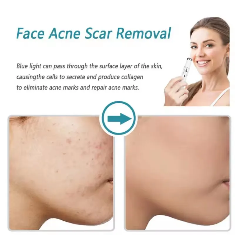 Perangkat Kecantikan Mata Tera - Acne Light Therapy Pen ulasan dan harga